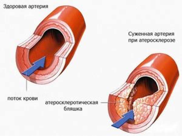 Физиопроцедуры при гонартрозе коленного сустава